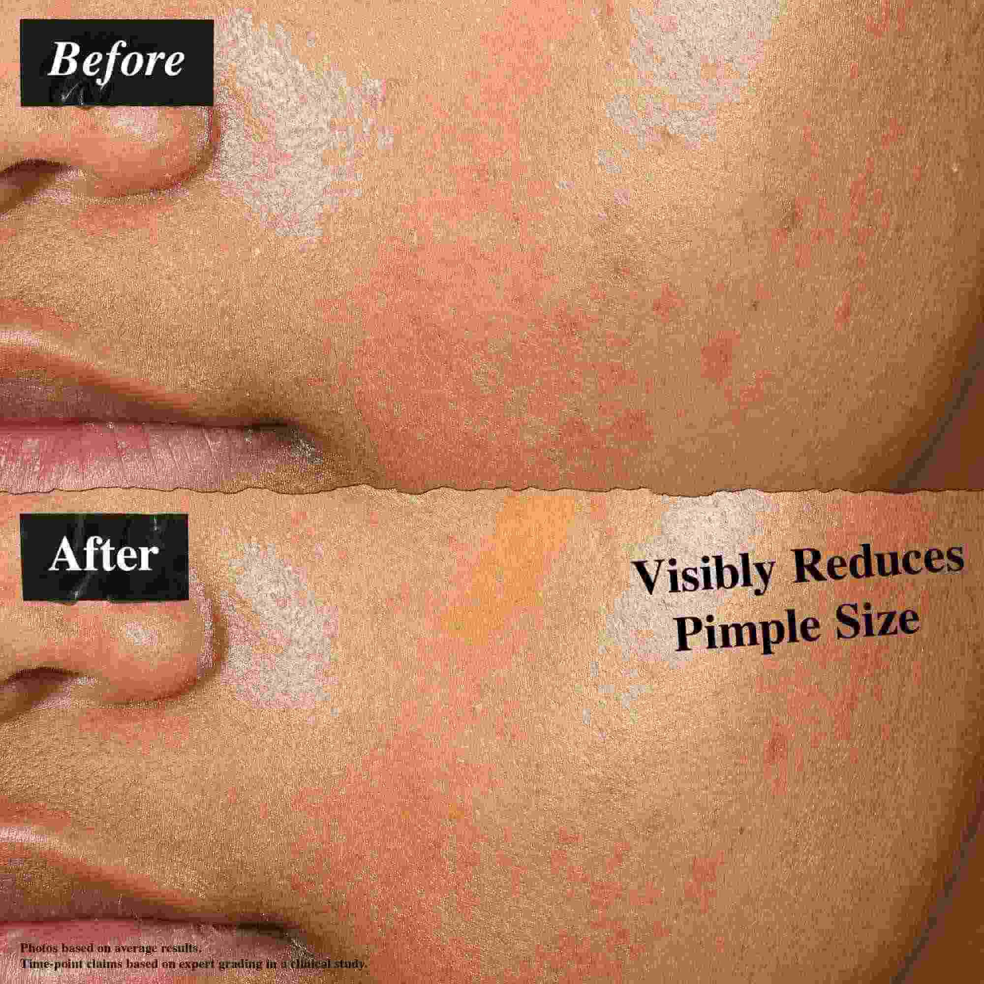 Primerjava prej in potem, ki prikazuje kožo, negovano s Truly-Targeted Blemish-Clearing Solution. Slika »prej« prikazuje vidne mozolje, slika »potem« pa zmanjšano velikost mozoljev.