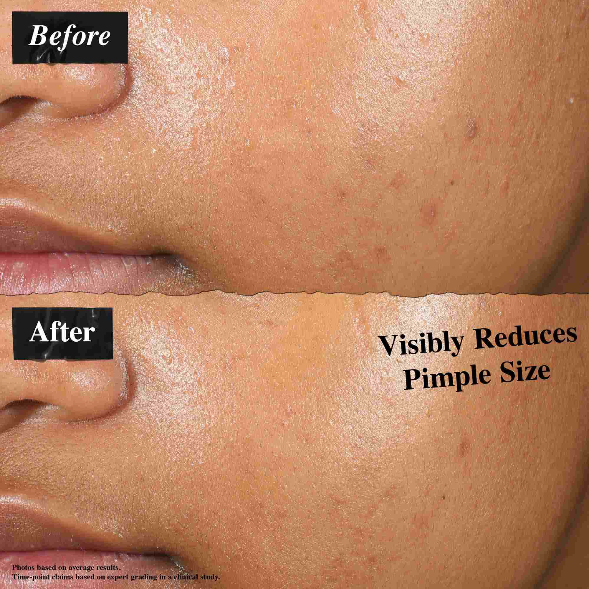Primerjava prej in potem, ki prikazuje kožo, negovano s Truly-Targeted Blemish-Clearing Solution. Slika »prej« prikazuje vidne mozolje, slika »potem« pa zmanjšano velikost mozoljev.