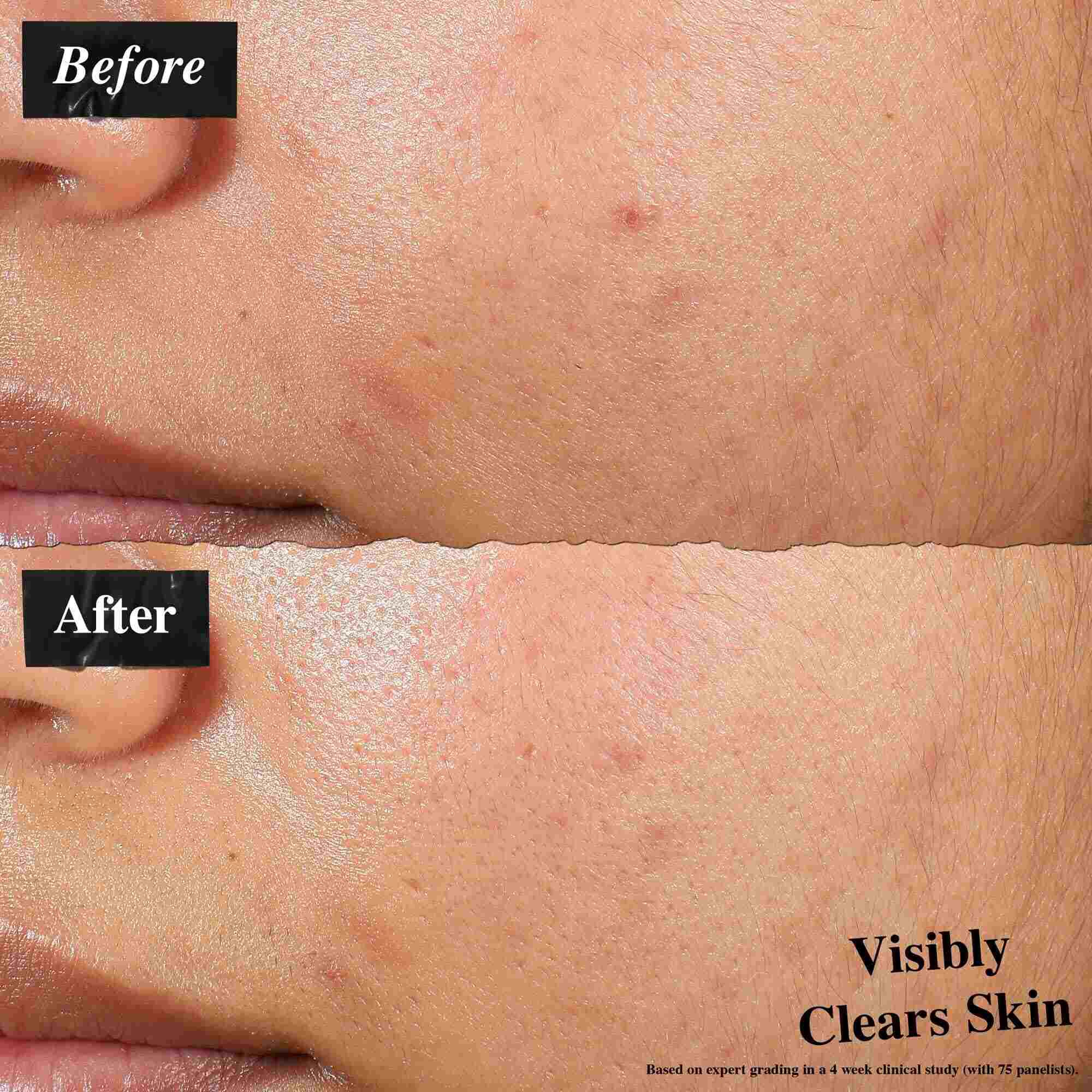 Primerjava prej in potem, ki prikazuje kožo, tretirano z Expertly Clear Blemish-Treating & Preventing Lotion. Slika »prej« prikazuje nepravilnosti in neenakomerno teksturo kože, slika »potem« pa vidno čistejšo kožo.
