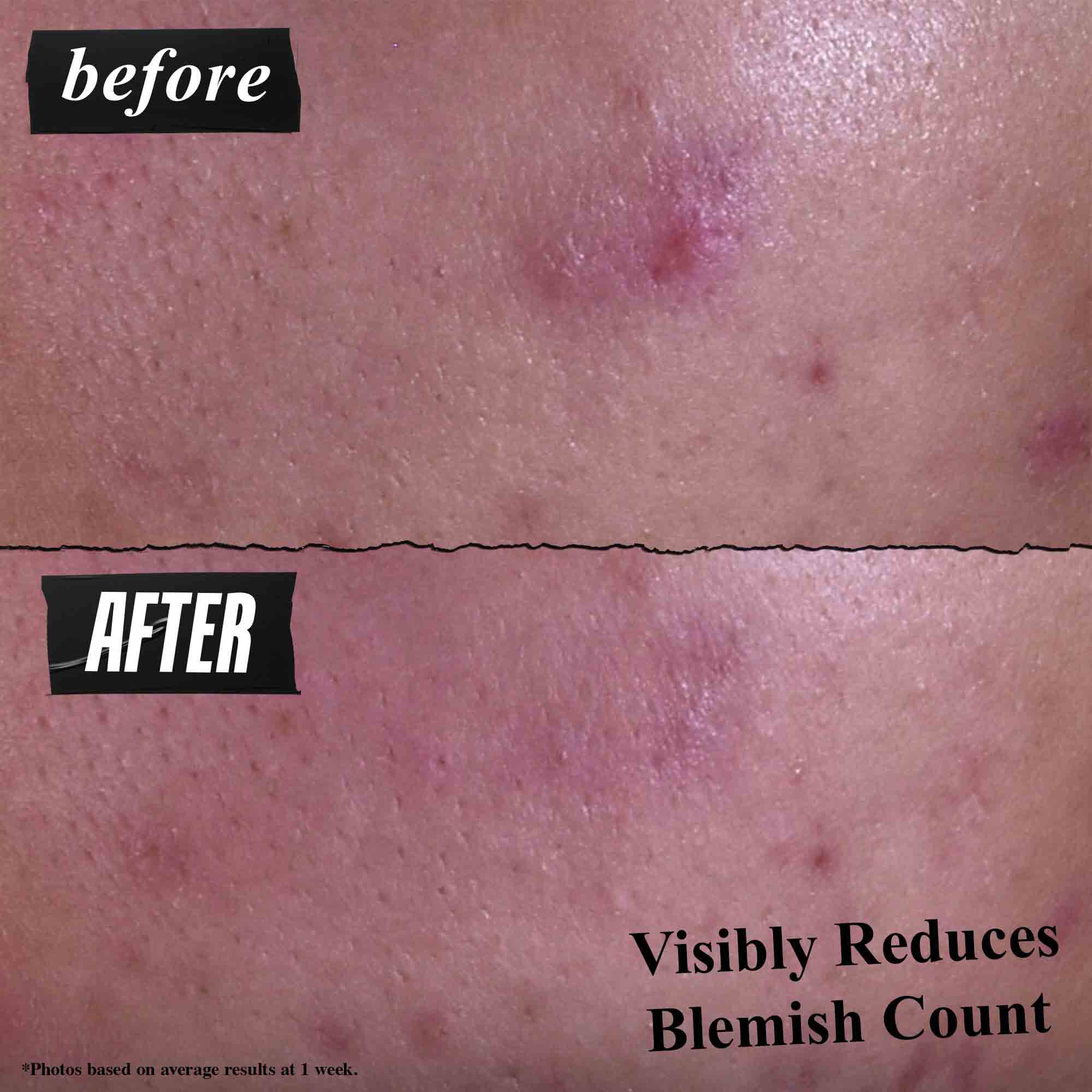 Gently Effective Blemish-Treating Cleansing Paste