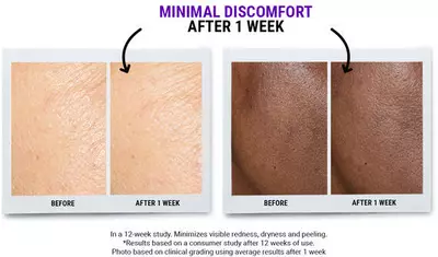 A side-by-side comparison of skin texture before and after one week of treatment, showing improved smoothness and reduced discomfort. The left shows "Before" results, while the right displays "After 1 Week" results, highlighting visible differences in skin condition.